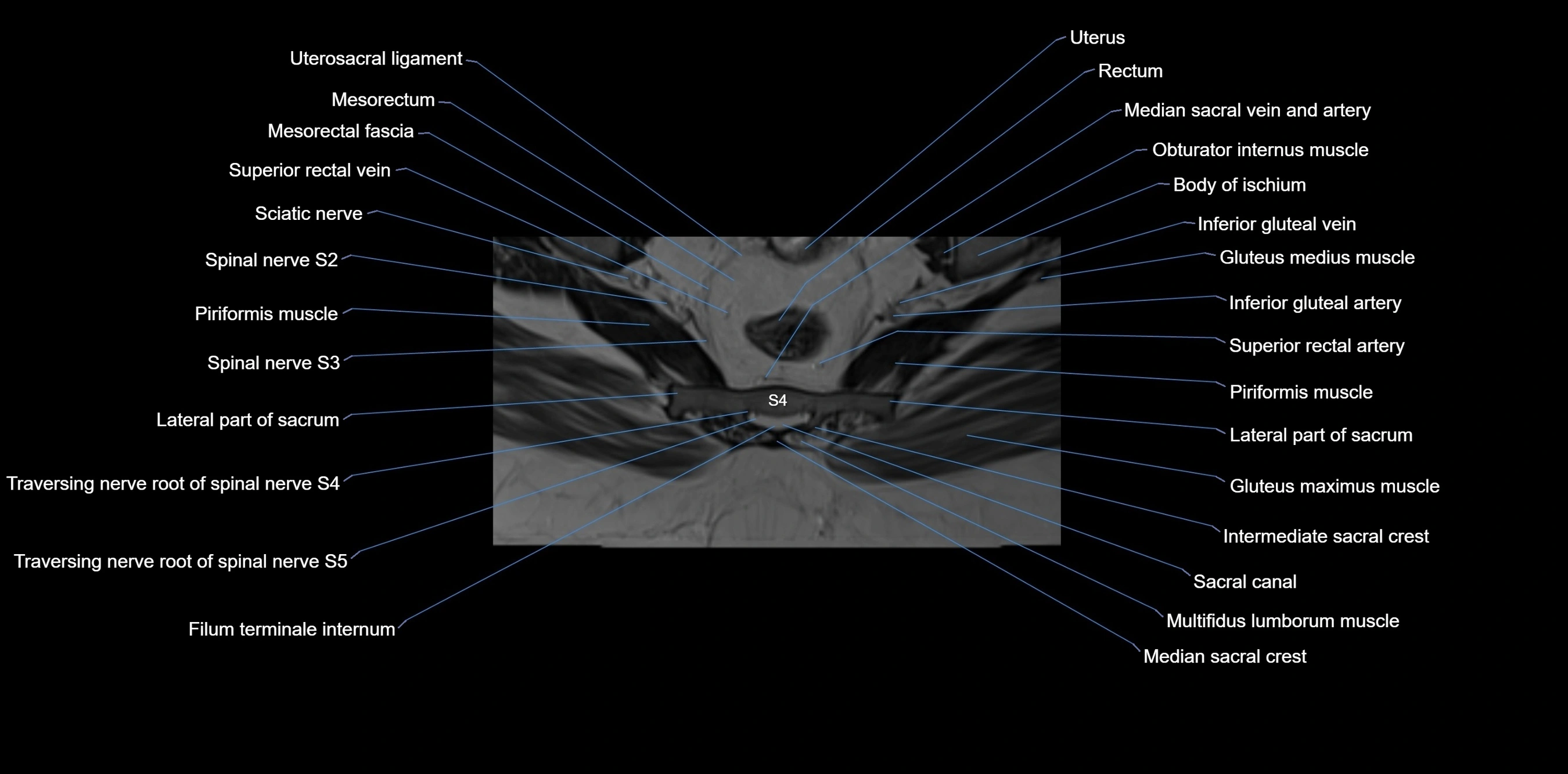 MRI sacrum, coccyx and sacroiliac joint axial cross sectional anatomy 3T  radiology  image-img-00001-00048.webp